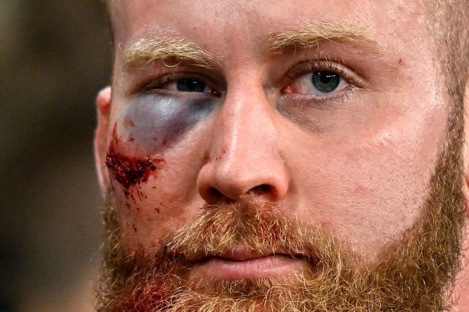 Jeremy Loughman of Munster wears the scars of battle after his side's defeat to Leinster at Croke Park. Photo: Sam Barnes/Sportsfile