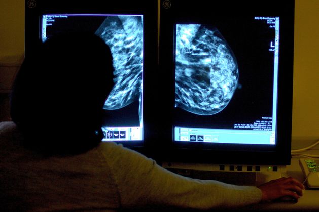 乳がんの発生率が最も高いのはアイルランドなどの裕福な国であることが研究で判明