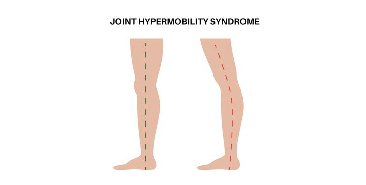 Stay Well: My ‘double-jointedness’ is down to hypermobility. What is it and will it cause me any issues?