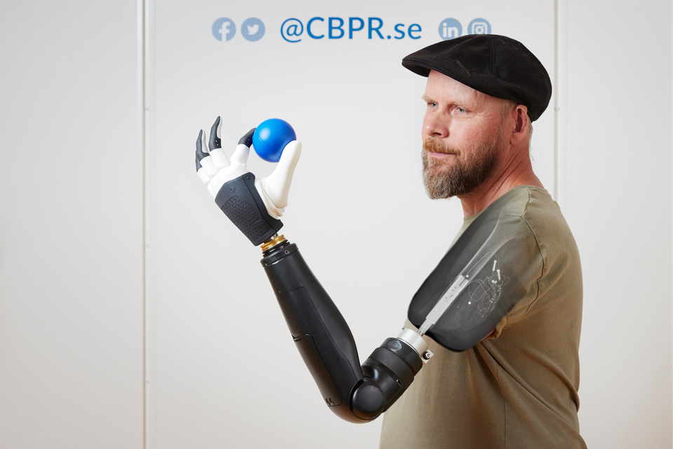 Tonney wearing a prosthetic arm directly attached to the skeleton and neuromuscular system, which after surgical reconstruction of his residual limb, allows him to control individual fingers of a bionic hand (Anna-Lena Lundqvist/Chalmers University of Technology)