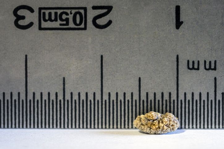 The Link Between Added Sugar and Kidney Stones