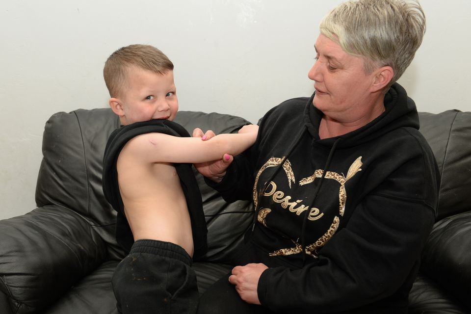 Adele Kenny shows where her grandson Parker was bitten