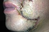thumbnail: The attack left Jimmy Griffin with a horrific scar (picture courtesy Jimmy Griffin)