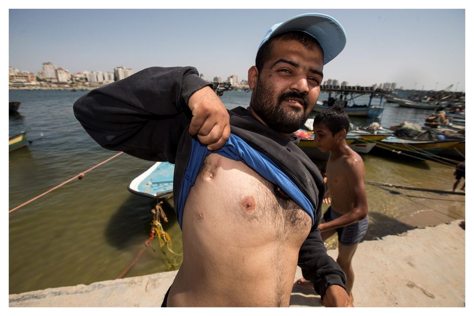 A fisherman shows the wounds he suffered after being shot while fishing off the coast of Gaza. Photo: Mark Condren