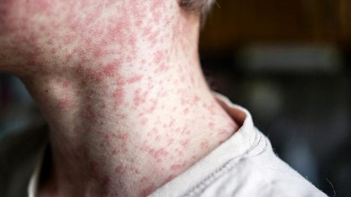 Urgent warning to Irish holidaymakers about measles outbreaks in European countries