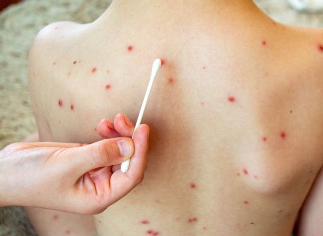 Case of measles in passenger who travelled on bus from Dublin Airport confirmed as HSE issues alert