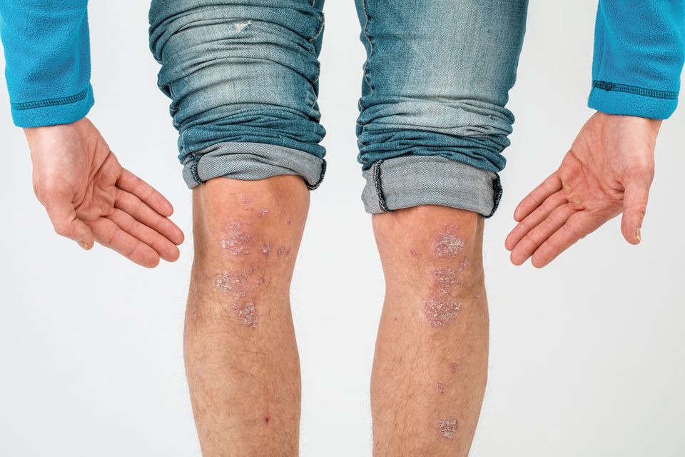 Ask the doctor: I have psoriasis on my face. Could a new rash on my legs be  related?
