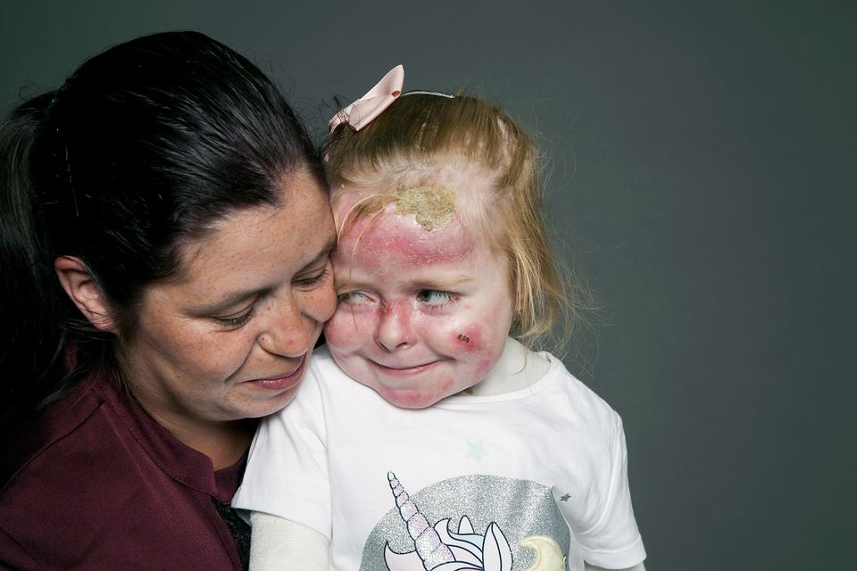 Dublin girl with EB overcomes fear of hospitals thanks to Bumbleance service