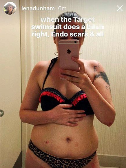 Lena Dunham proudly posts bikini selfie with endo scars and all