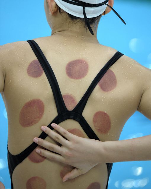 Chinese swimmer Wang Qun is seen with marks after cupping treatment during a training session at the National Aquatics Center a few days before the start of the Beijing 2008 Olympic Games on August, 04 2008.  There are 32 swimming gold medals up for grabs at the Olympics, making it the second most prolific sport behind track and field.     AFP PHOTO / DDP / MICHAEL KAPPELER  (Photo credit should read MICHAEL KAPPELER/AFP/Getty Images)