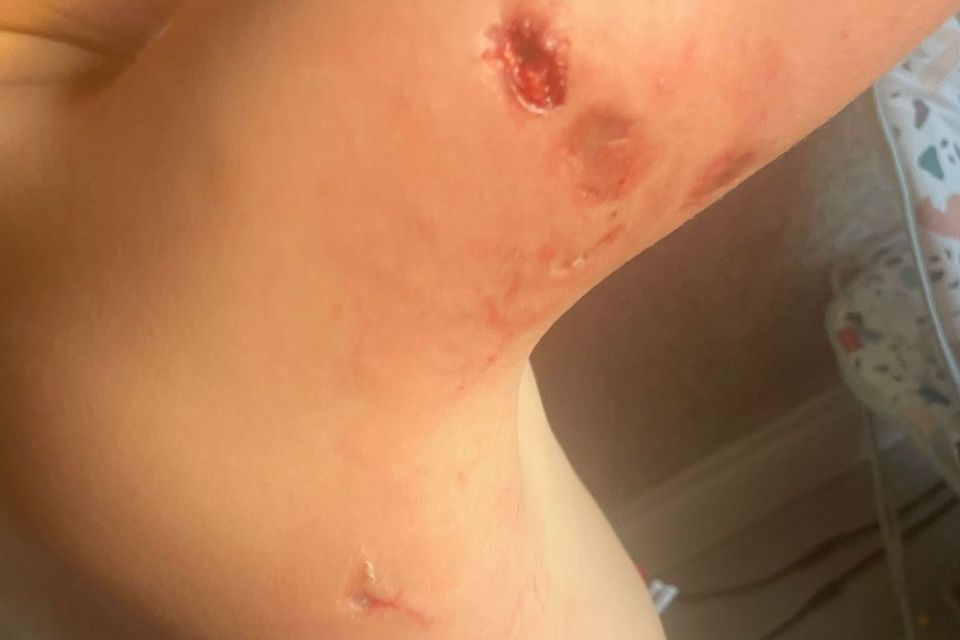 Bite marks on Perker, who was just four years old when he was attacked by an American Bully