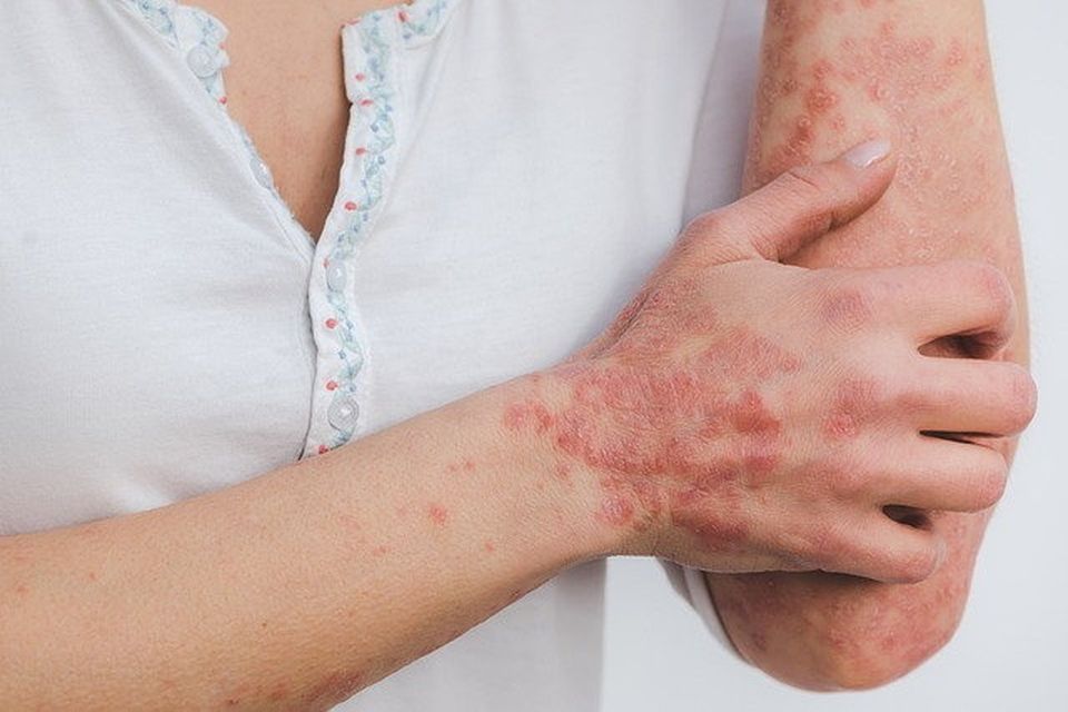 Psoriasis can appear anywhere on the body, but common places are the elbows, knees, lower back, and scalp. 