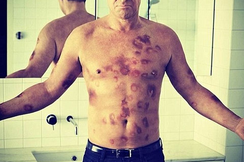 Ouch! Shane Warne displays some serious bruises, after rumours of night  with bra boss