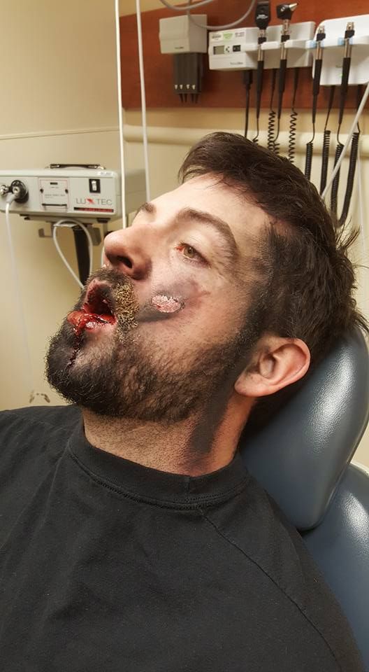 Graphic images show injuries suffered by man after vape pipe explodes in  face | Irish Independent