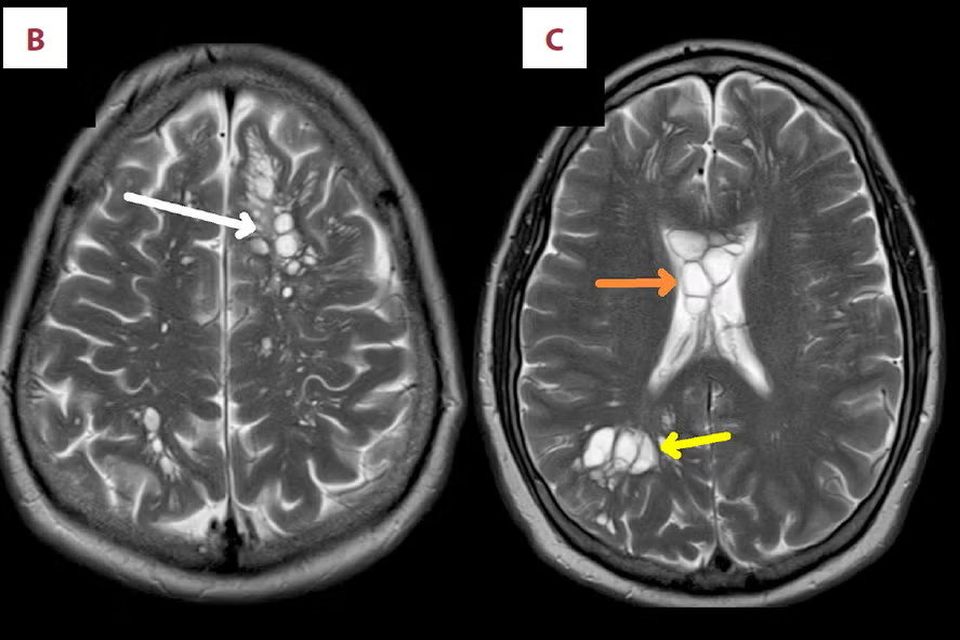 An X-ray image of the patient's brain published in the 'American Journal of Case Reports'