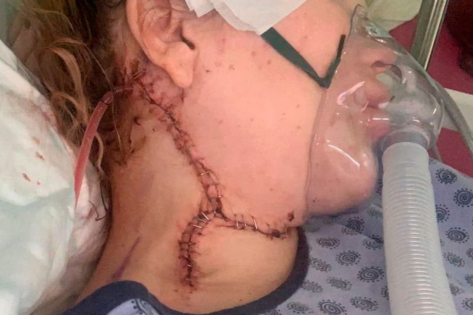 Tazmyn after having her lymph nodes removed at 23 weeks pregnant.