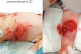 thumbnail: The girl's injuries, as photographed by the Irish Medical Journal