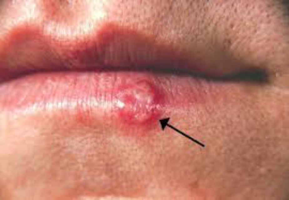 An unsightly cold sore