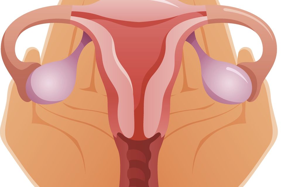 One in 10 Irish women suffer from polycystic  ovary syndrome