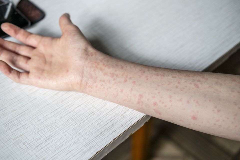 Measles Scare: Dublin Creche Alert