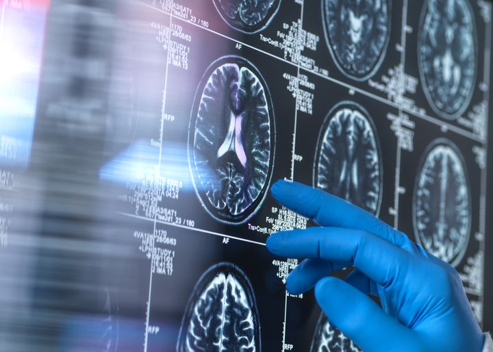 Treatment to slow Alzheimer’s approved, but €60,000 yearly price not covered by HSE or insurance