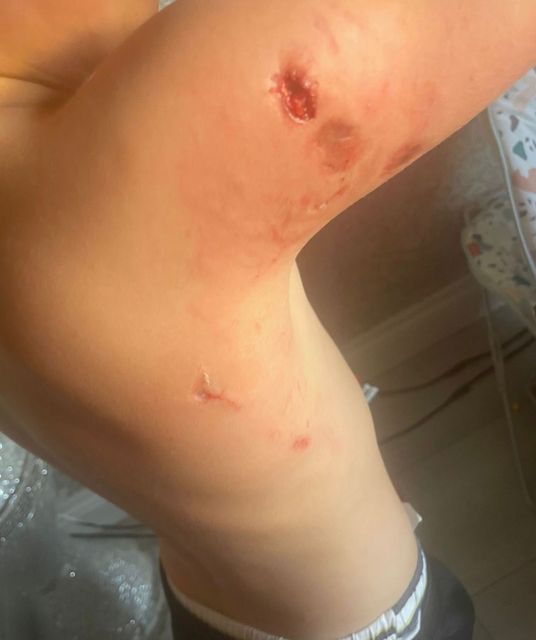Bite marks on Perker, who was just four years old when he was attacked by an American Bully