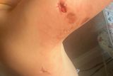 thumbnail: Bite marks on Perker, who was just four years old when he was attacked by an American Bully