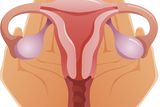 thumbnail: One in 10 Irish women suffer from polycystic  ovary syndrome