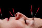 thumbnail: Acupuncture