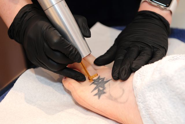 No more tattoo tears as laser treatment removes regrets | Irish Independent