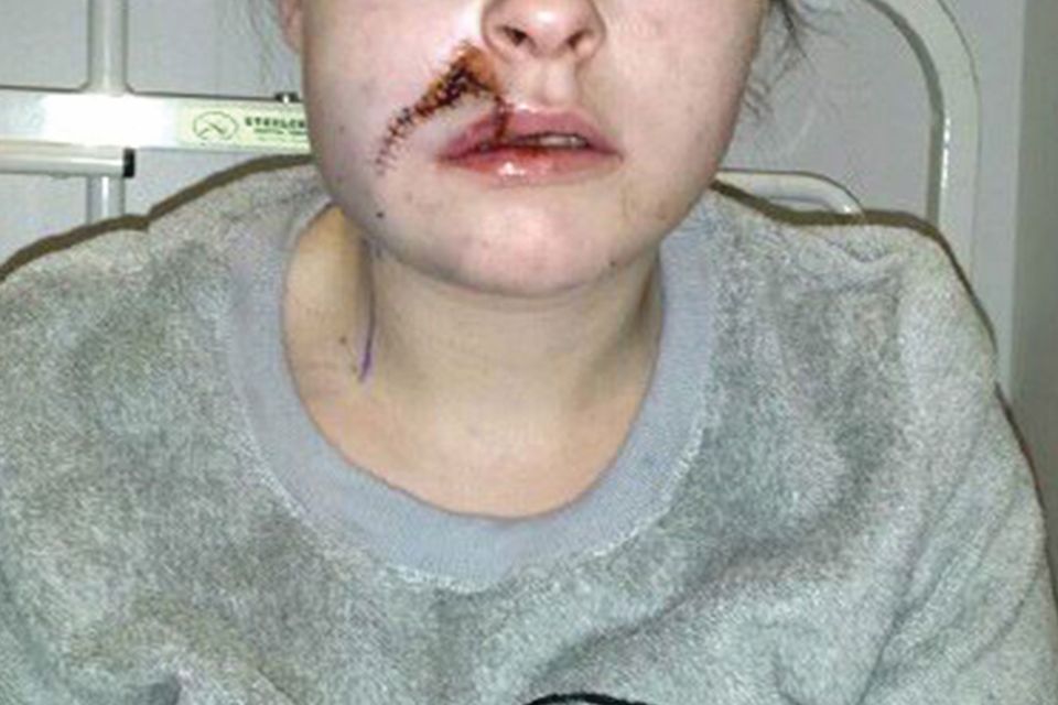 Nicole Dwyer from Wexford town. Nicole was attacked with a hatchet on the evening of Monday January 12, 2014