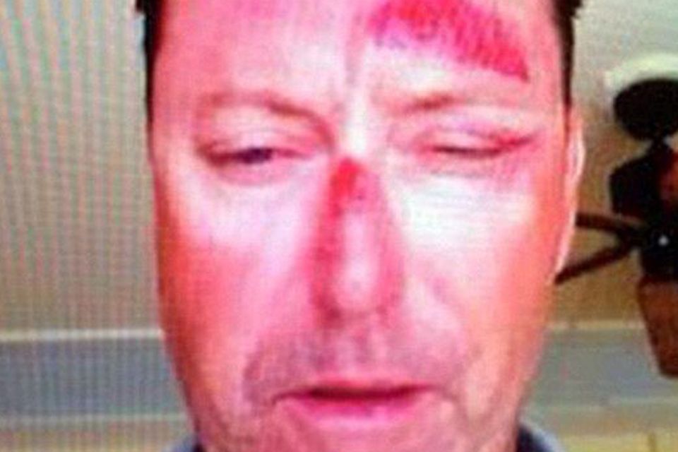 Robert Allenby injuries