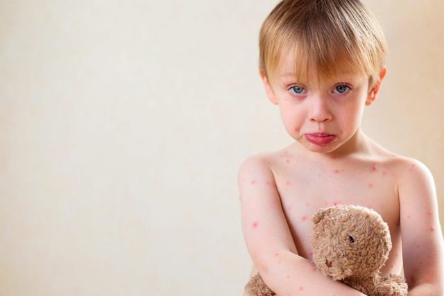 15 things to know about chickenpox | Irish Independent