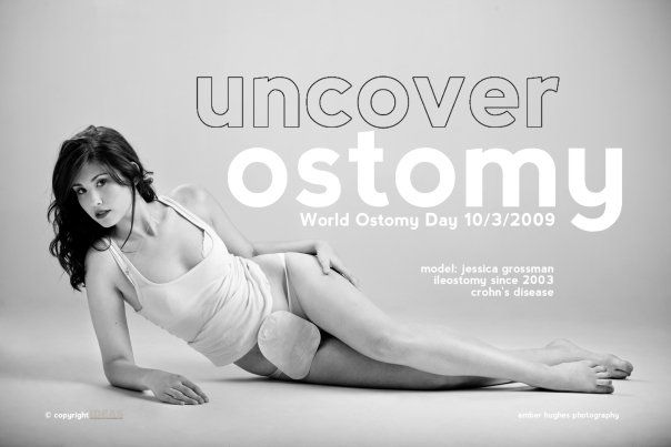 Ostomy Awareness: The #AerieREAL Campaign - Uncover Ostomy